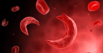 Sickle Cell Disease Workshop Sickle Cell Disease Workshop